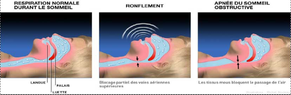 La polygraphie – Apnée du sommeil
